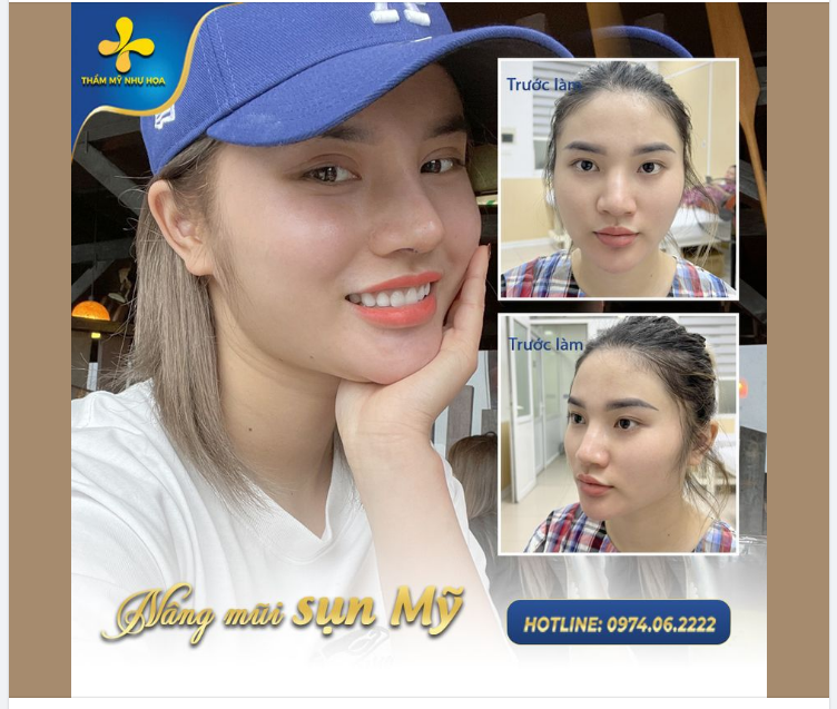 ƯU ĐIỂM CỦA PHƯƠNG PHÁP NÂNG MŨI SỤN MỸ MÀ KHÁCH HÀNG KHÔNG THỂ BỎ QUA