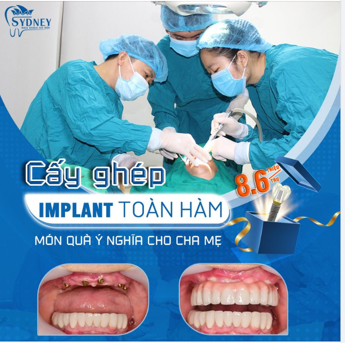 Ưu điểm vượt trội của cấy ghép Implant toàn hàm