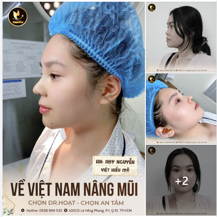VỀ VIỆT NAM NÂNG MŨI  CHỌN DR. HOẠT – CHỌN AN TÂM
