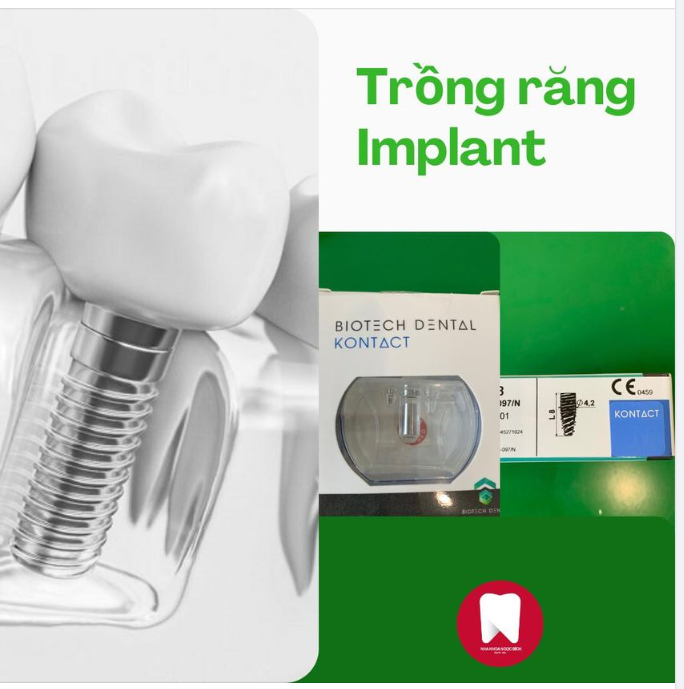 VÌ SAO NÊN TRỒNG RĂNG IMPLANT CÀNG SỚM CÀNG TỐT