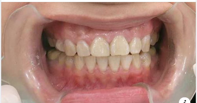 Vì sao phải gắn răng tạm khi trồng răng implant?