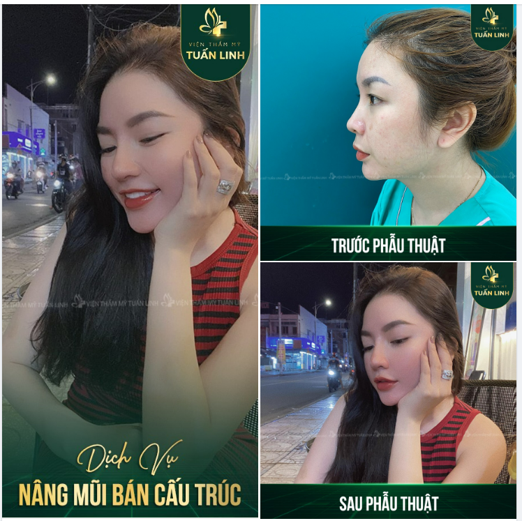 Với những ai mũi ít khuyết điểm chỉ cần nâng mũi bán cấu trúc như bạn này là đã đẹp xỉu rồi