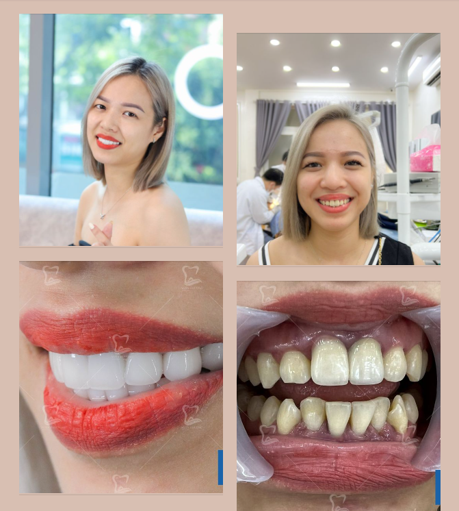 Vượt 3000km làm răng cùng bác sĩ Ngân Phượng
