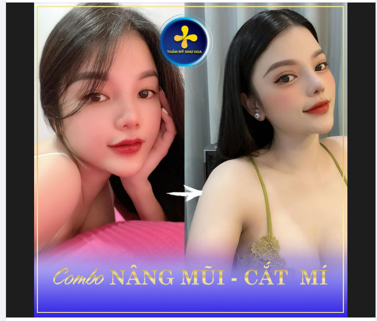 X2 SẮC ĐẸP VỚI COMBO NÂNG MŨI CẮT MÍ