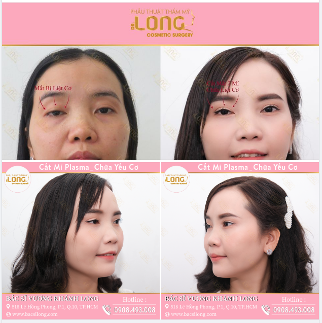 XINH LÊN TRONG PHÚT CHỐC NHỜ CHỈNH MẮT YẾU CƠ