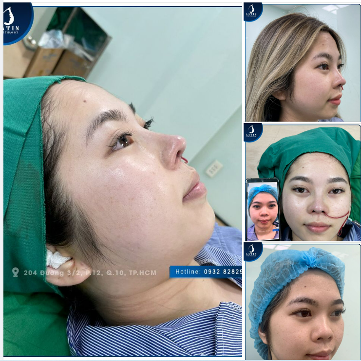 Xóa bỏ tự ti mũi ngắn, hếch , mũi không đẹp