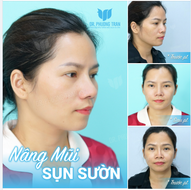 “Xót xa” cho chiếc mũi GỒ GHỀ vì…GỌT SỤN SAI CÁCH