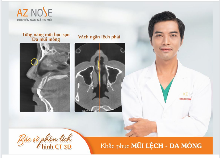 Xử lý tình trạng mũi th.ô - l.êc.h sóng cho khách hàng Biên Hòa