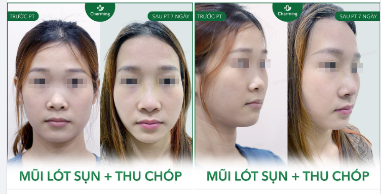 Yêu cầu của khách là cần mũi cao hơn 1 xíu, nhìn tự nhiên là được.