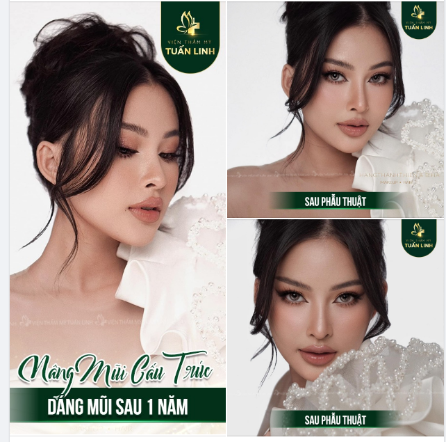ZOOM CẬN CẢNH FORM MŨI SAU 1 NĂM TẠI TUẤN LINH