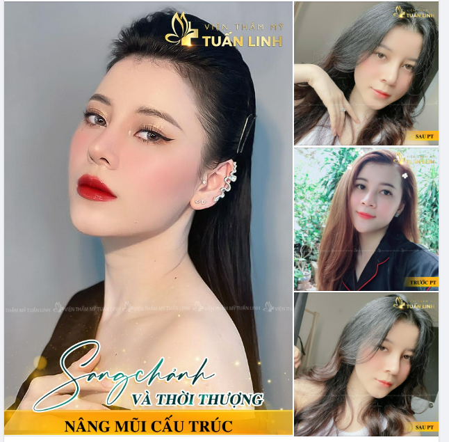 1 phút quyết định 90 phút thực hiện ​​​​​​​ 10 ngày tháo nẹp