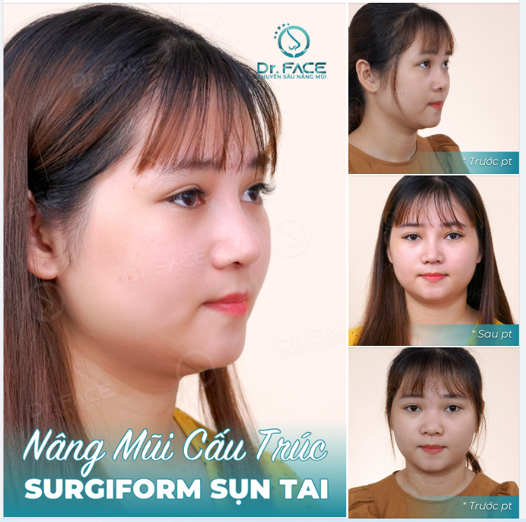 Anh mất ngủ chẳng phải do trà. Suy đi nghĩ lại chắc là nhớ em. Mỗi một cô gái xinh đẹp đều có bí quyết riêng. Với cô bạn này, đó là nâng mũi cấu trúc.
