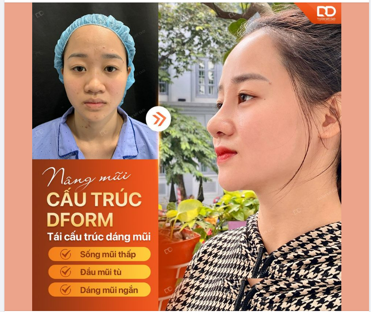 NÂNG MŨI CẤU TRÚC DFORM CÓ CẦN GÂY MÊ KHÔNG?
