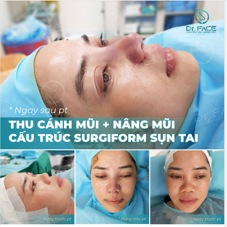 KHOE CA MŨI ĐẦU NGÀY VỪA XONG, BẠN THẤY SAO?