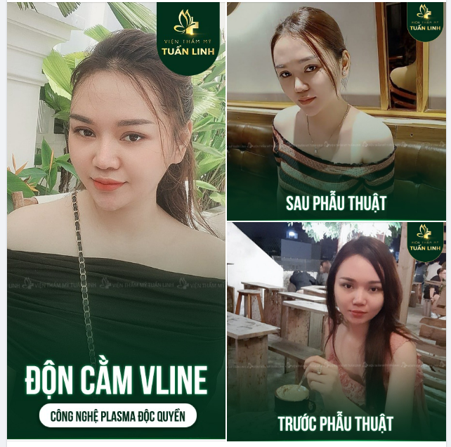 ĐỘN CẰM VLINE CÔNG NGHỆ PLASMA ĐỘC QUYỀN