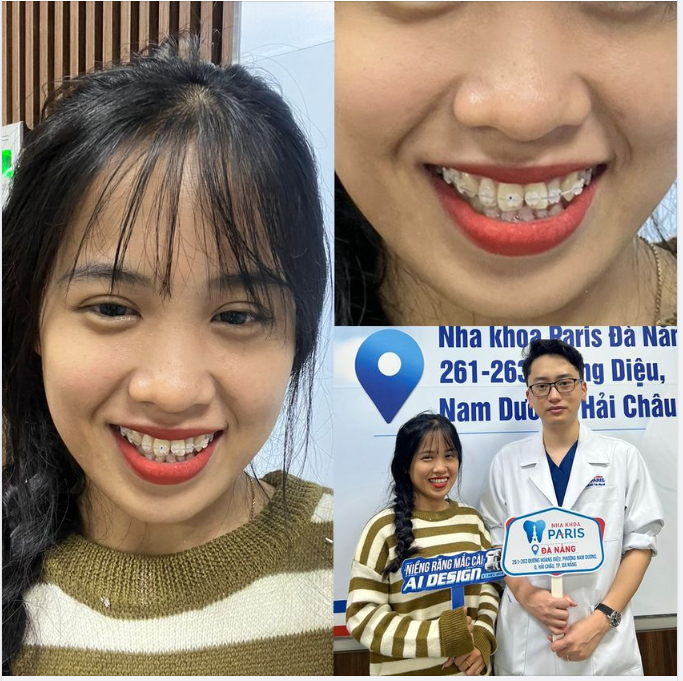 Bạn có nhận ra sự khác biệt so với mắc cài sứ thông thường???