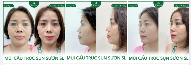 Trước đây khách đã từng nâng mũi nhưng bắt đầu có dấu hiệu bóng đỏ đầu mũi và lộ sóng mũi.