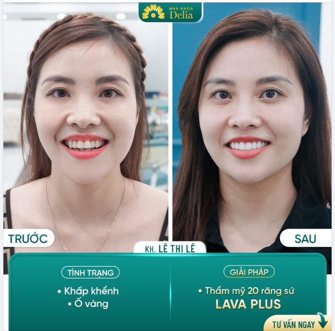 48H Răng Hết Ố Vàng, Khấp Khểnh