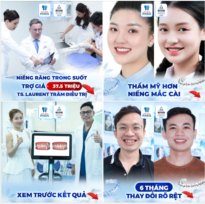 Niềng như không niềng - Đẹp kịp Tết