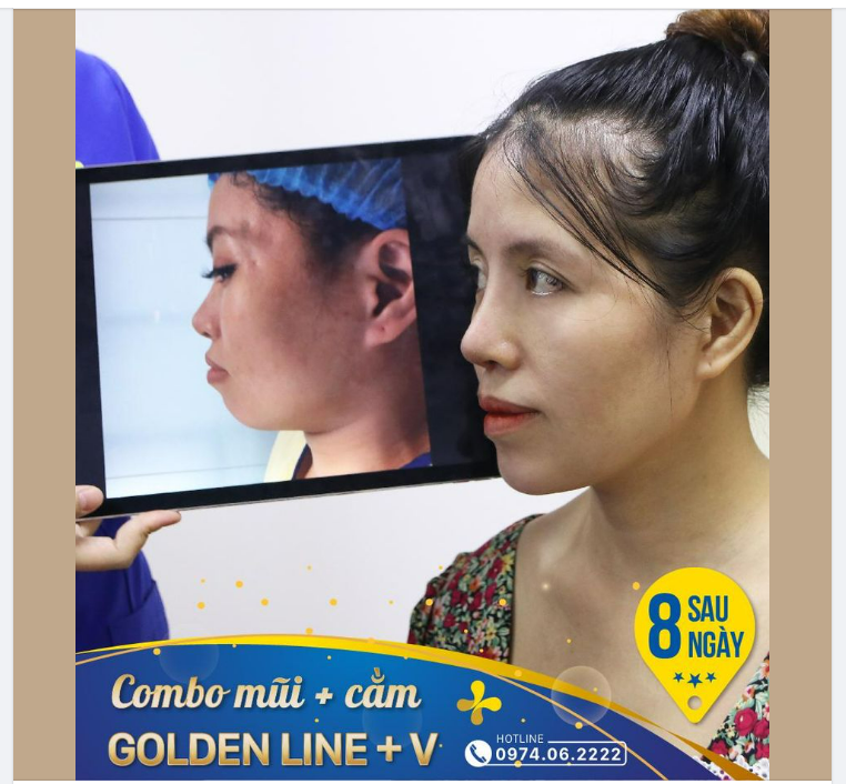 COMBO MŨI GOLDEN LINE - CẰM GOLDEN V SAU 8 NGÀY