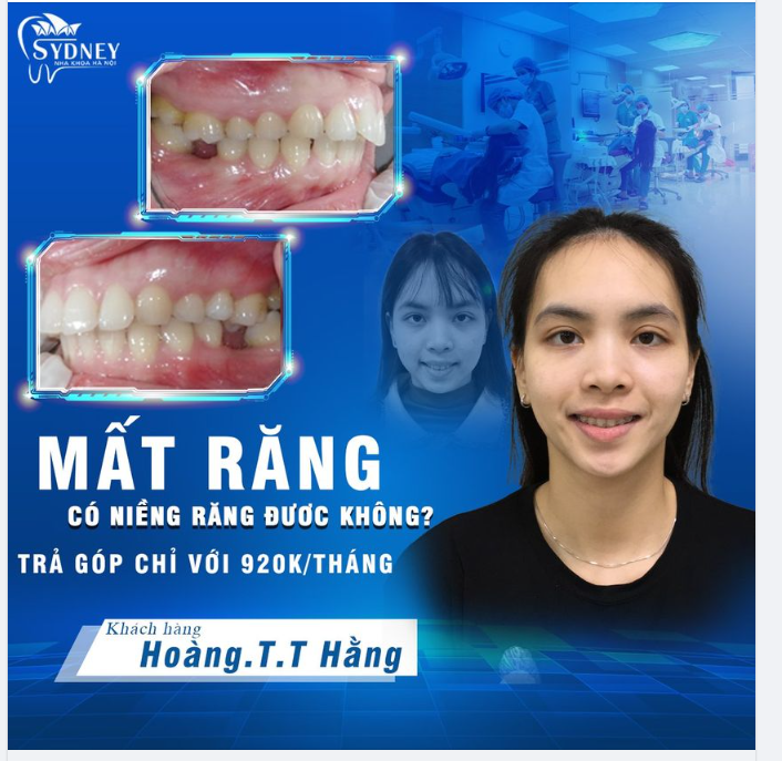 Mất răng có niềng được không?