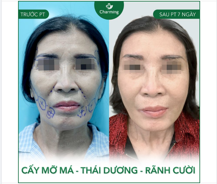 Đúng là thời gian lấy đi của con người ta nhiều thứ, trong đó có cả mỡ má, mỡ thái dương, mỡ rãnh cười,…
