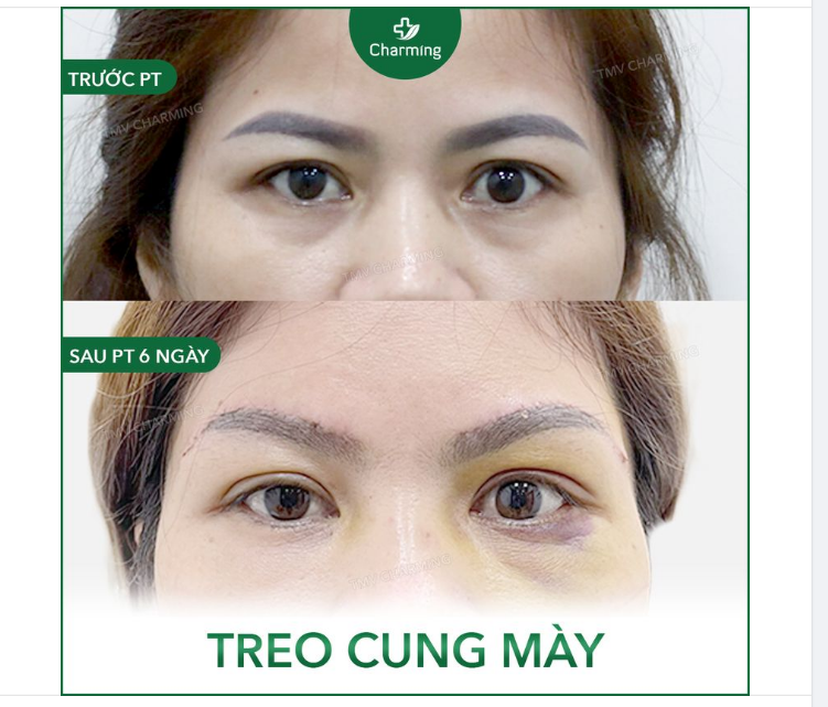 Lại thêm một ca nâng cung mày do xăm lỗi ​​​​​​​