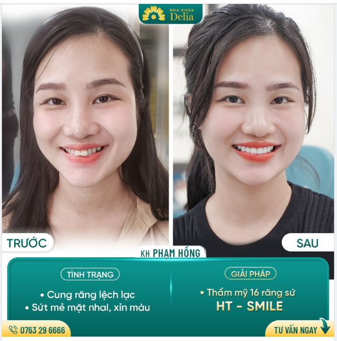 Chỉ sau 02 lần hẹn, chị Phạm Hồng đã sở hữu hàm răng trắng sáng dạng rỡ