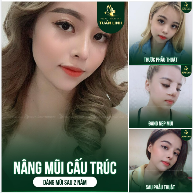 MUỐN NÂNG MŨI BỀN ĐẸP - CHỌN NGAY TUẤN LINH 
