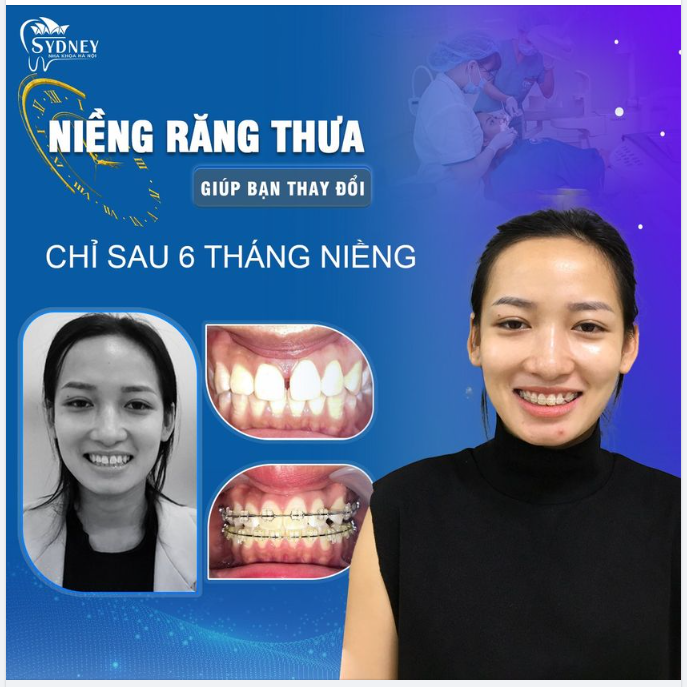 Niềng răng – Khắc phục tình trạng răng thưa của bạn