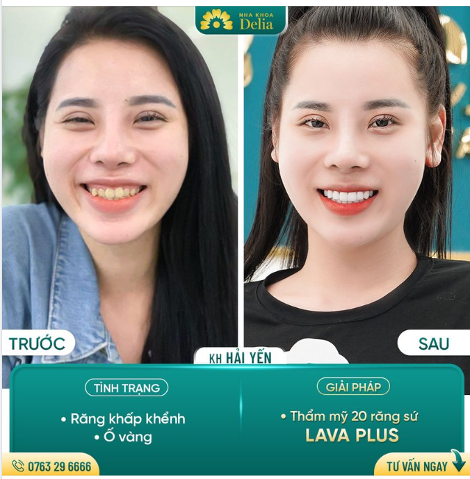 Thẩm mỹ 20 răng sứ Lava Plus - Thay đổi diện mạo gương mặt chỉ sau 48h