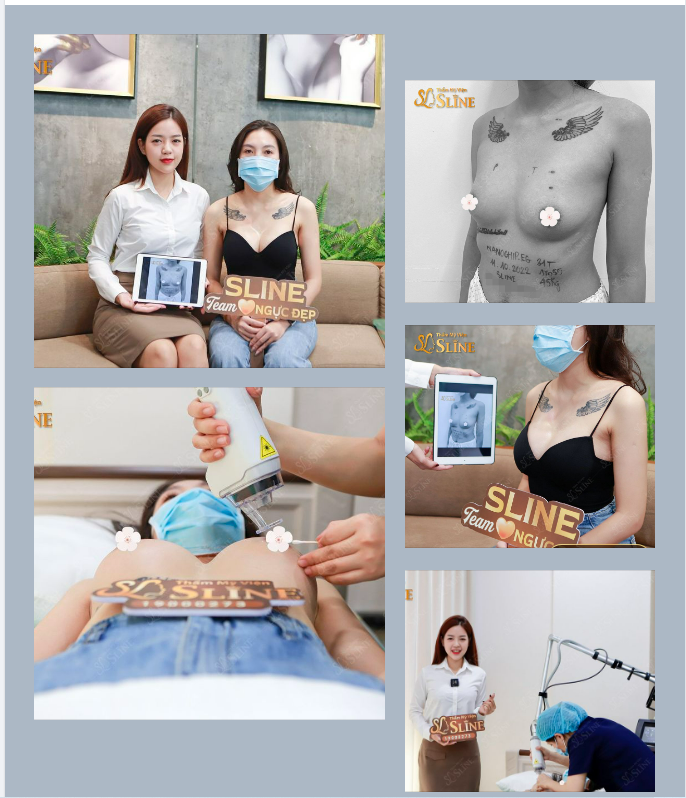 Nâng ngực với Ekip Sline sau 1 tháng.