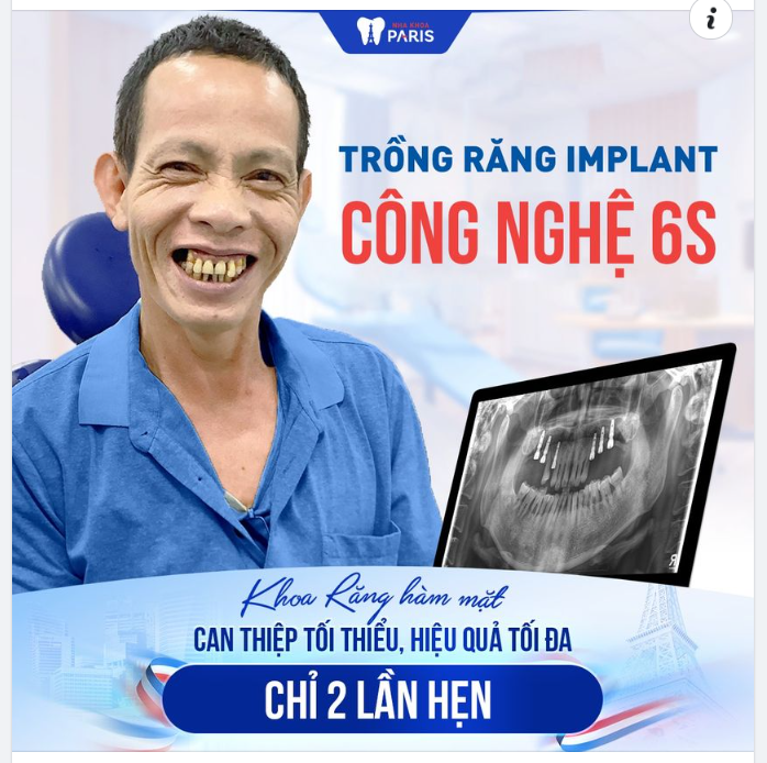 ĐỘT PHÁ CÔNG NGHỆ TRỒNG RĂNG IMPLANT 6S