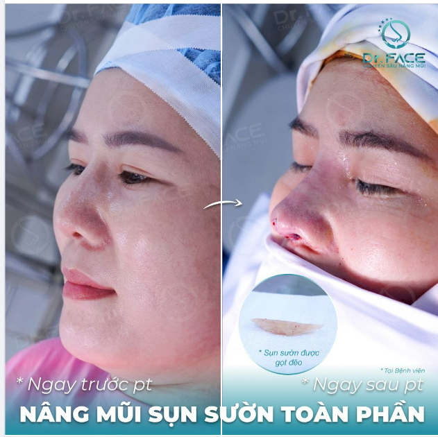 PHẢI DỪNG 2 PHÚT ĐỂ NGẮM CA MŨI SỤN SƯỜN NÀY