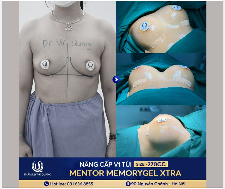 Ekip Bác sĩ Vũ Quang thực hiện nâng ngực nội soi công nghệ cao kết hợp đặt túi Mentor Extra.