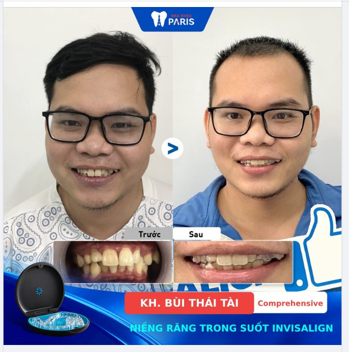 NIỀNG TRONG SUỐT TẠI NHA KHOA PARIS: RĂNG HÔ -KHẤP KHỂNH KHÔNG CÒN LÀ NỖI LO