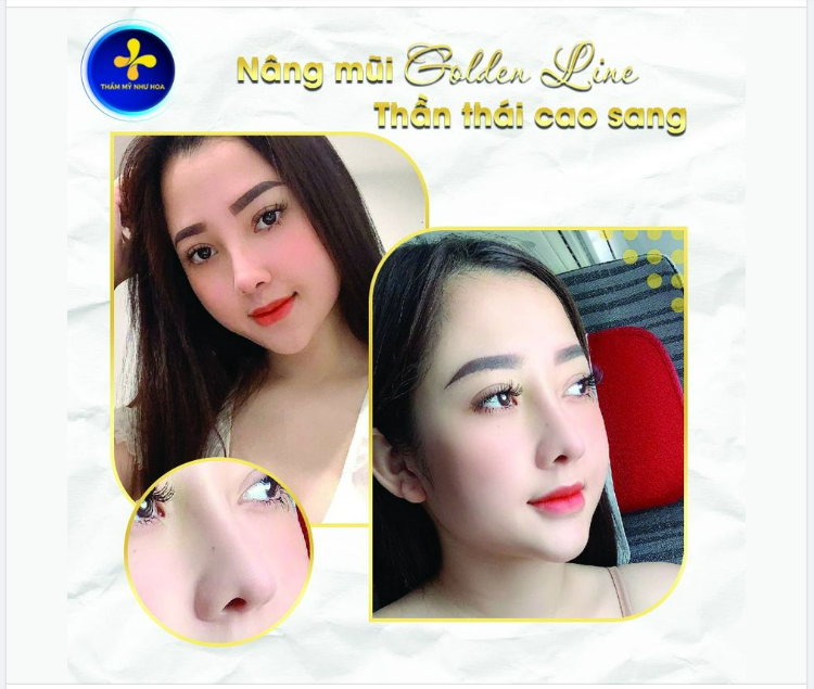 Thay đổi hoàn toàn chỉ với 1 dịch vụ. Cùng ngắm nhìn thành quả của khách hàng nâng mũi Golden Line tại Thẩm mỹ Như Hoa nhé.