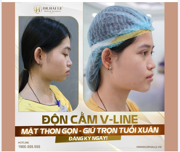 ĐỘN CẰM VLINE – CHINH PHỤC NGAY NÉT ĐẸP THỜI THƯỢNG