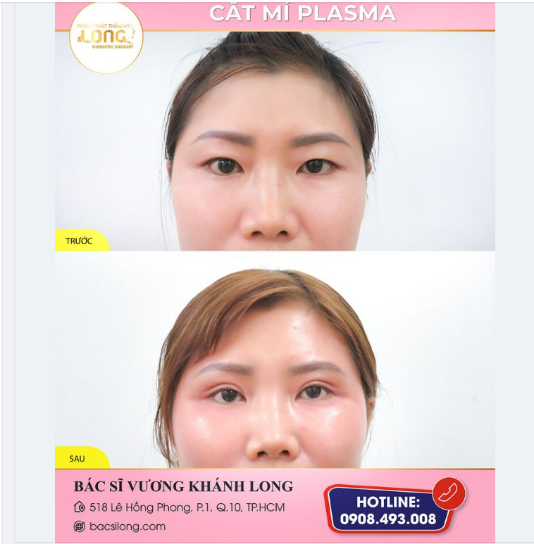 ​​​​​​​Mắt 2 mí đủ xinh giúp khách hàng thêm tự tin khi xuất hiện trước mọi người