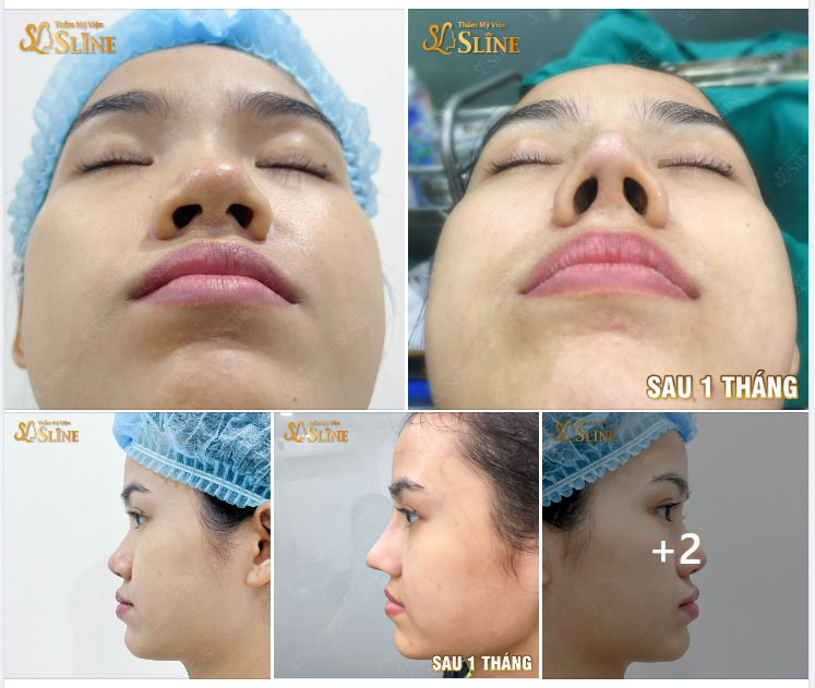 Sống mũi thấp, gồ sẽ thay đổi như thế nào