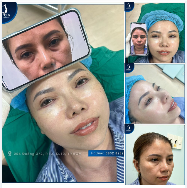 Trẻ hơn sau khi làm dịch vụ cắt mí dưới, xử lý da thừa kết hợp cấy mỡ vùng hốc mắt tại Latin