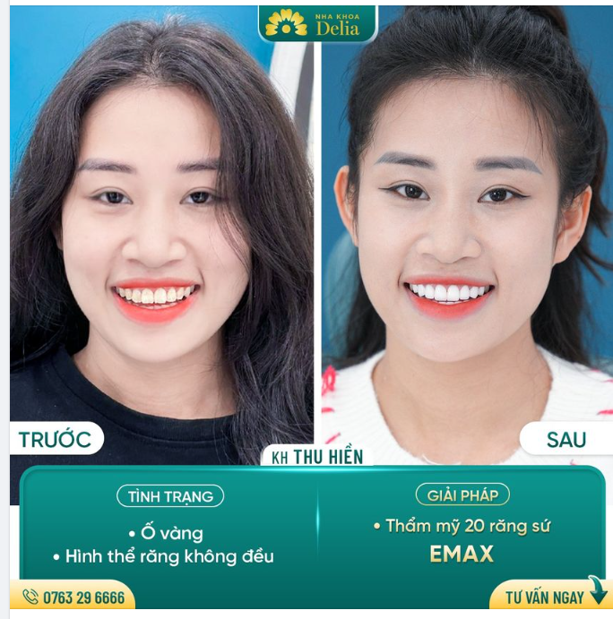 Khách hàng Thu Hiền khắc phục mọi nhược điểm: Răng khấp khểnh - Ố vàng sau thẩm mỹ 20 răng sứ Emax tại Delia.