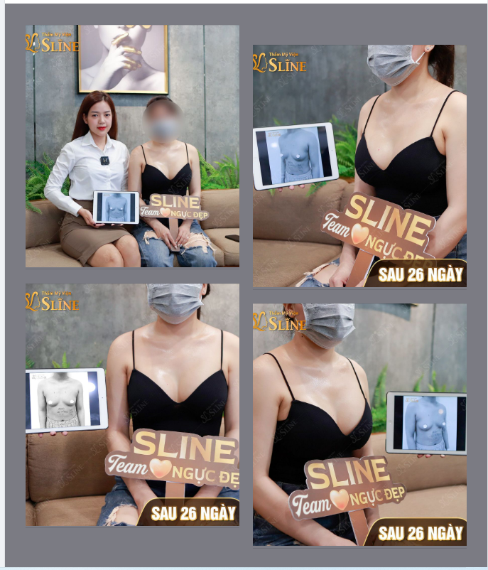 NGỰC ĐẸP cùng SLINE