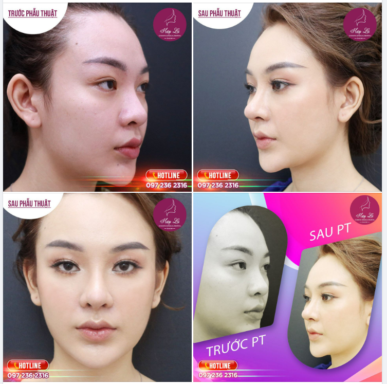 ĐÁNH THỨC NÉT ĐẸP TIỀM ẨN CHỈ SAU 60' ĐIỀU CHỈNH DÁNG MŨI