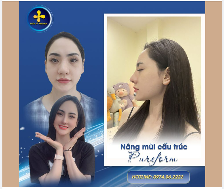 Phẫu thuật nâng mũi không còn là điều quá lạ với chị em phụ nữ. Một dáng mũi cao, thanh thoát, hài hòa với khuôn mặt là điều tất cả các chị em ao ước.