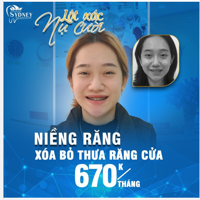 Tại sao nên niềng răng thưa?