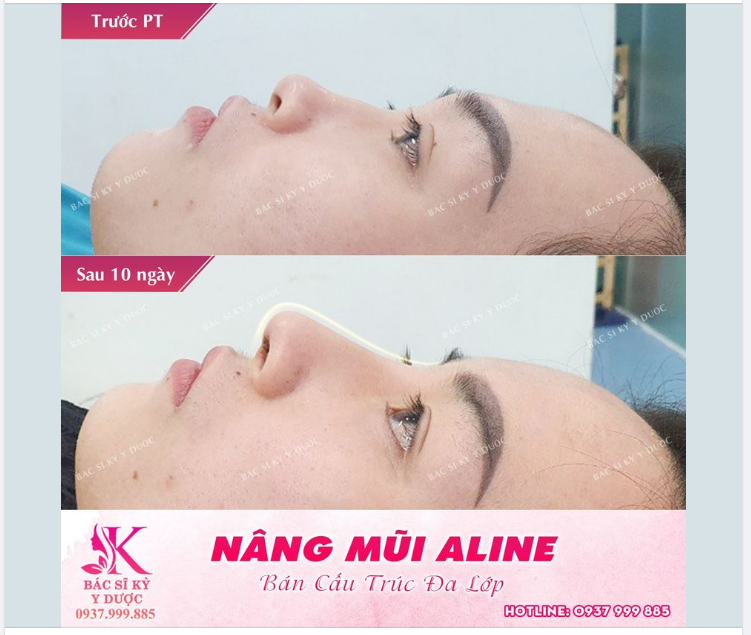 Dành cho chị em thích nhẹ nhàng - Chọn ngay dáng mũi ALINE độc quyền