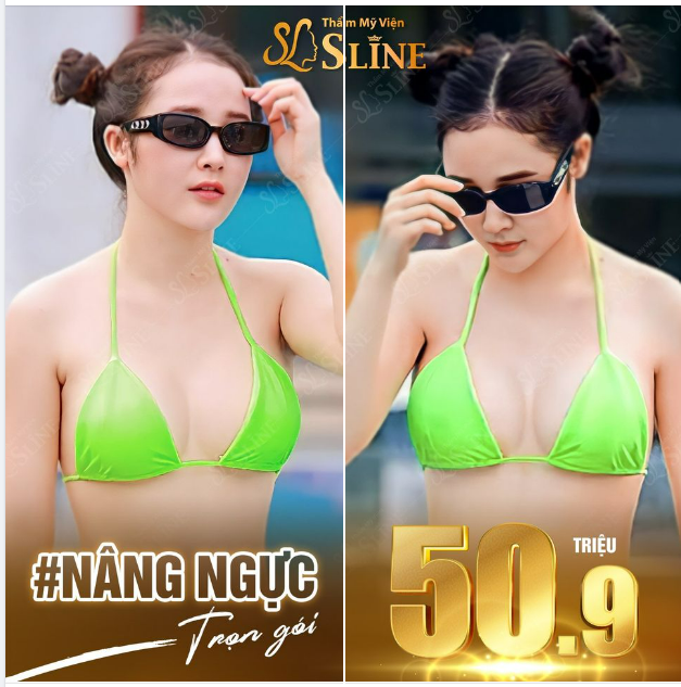Nâng ngực trọn gói 50,9tr