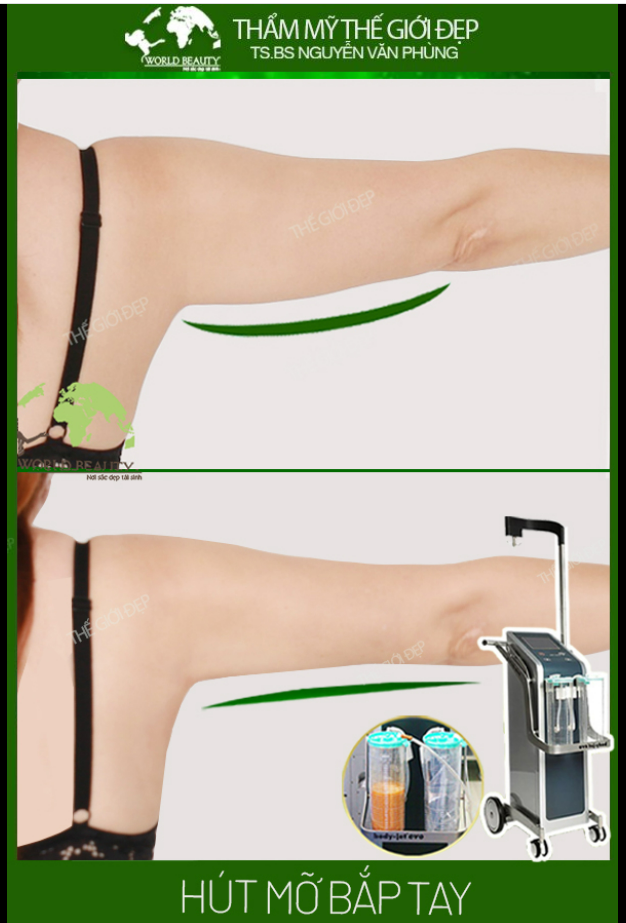 Hút mỡ Body Jet Evo luôn là giải pháp hữu hiệu hàng đầu cho Cô nàng có bắp tay to.