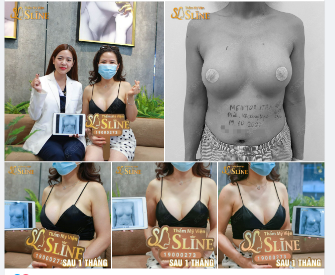 Feedback thực tế. Chị ấy bay từ ÚC về về thay túi ngực sau 13 năm đặt túi.
